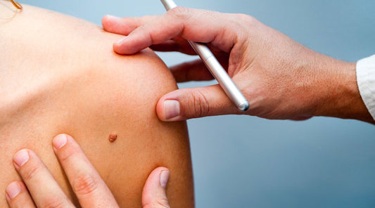 The A B C D E of skin checking